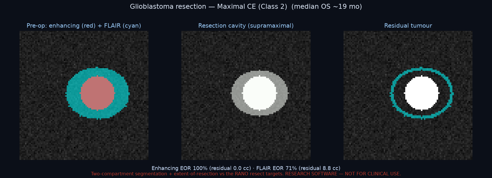 Glioblastoma resection β extent of resection