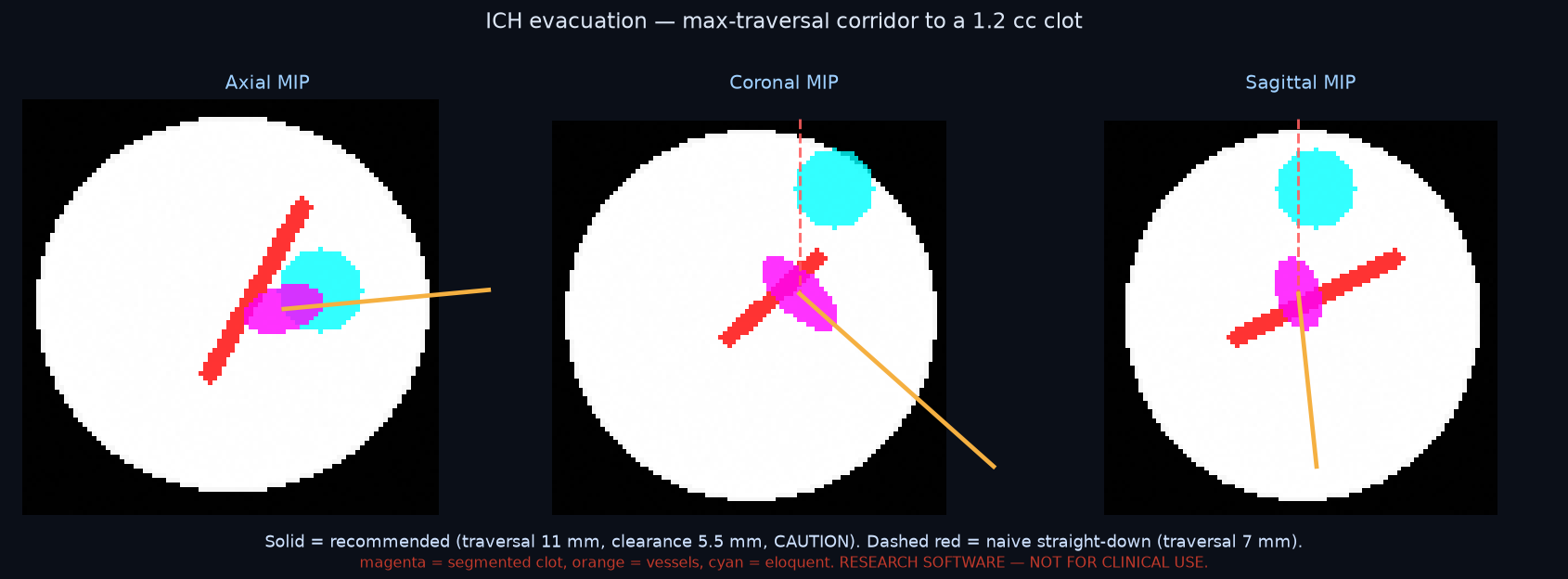 ICH evacuation β max-traversal corridor